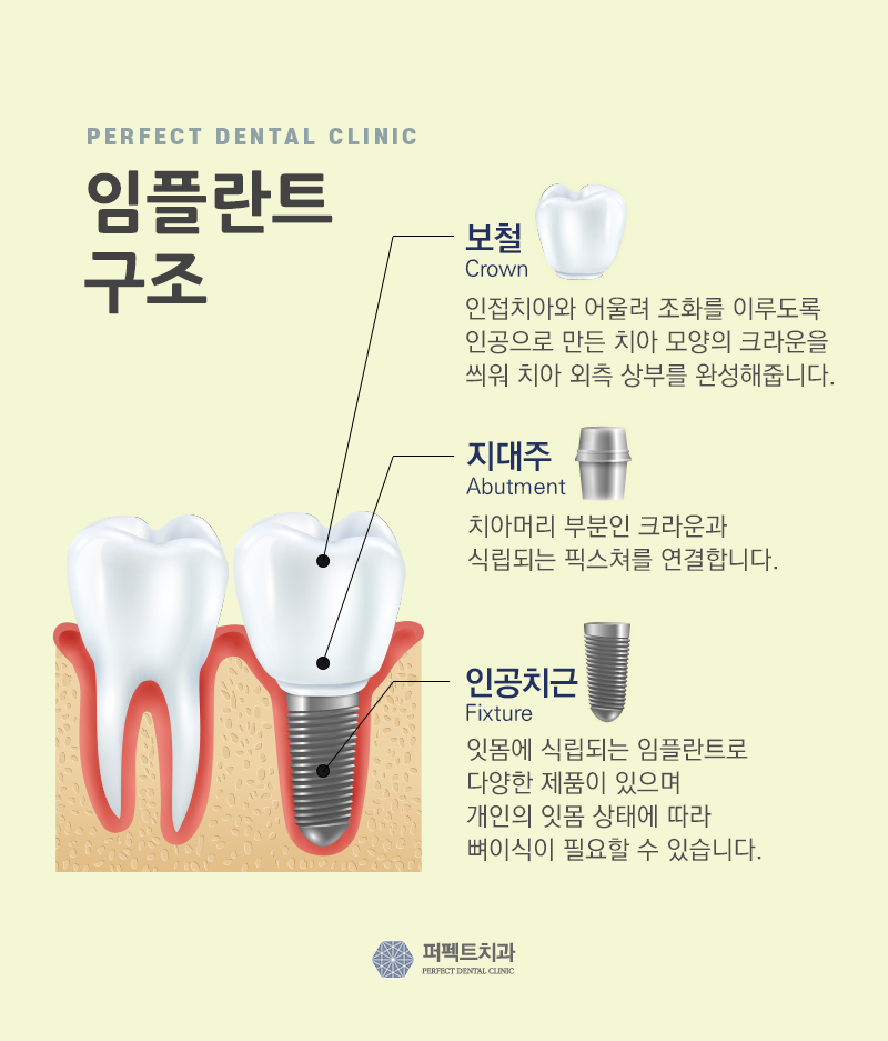 오스템임플란트 가격 관련 이미지 3