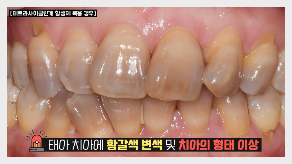 임신중 치과진료를? 주의사항 확인하기 관련 이미지 7