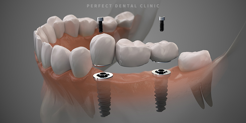 치과 앞니 브릿지 가격 관련 이미지 1