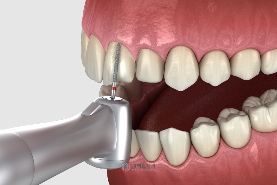 특별한 라미네이트가 있을까? 관련 이미지 3