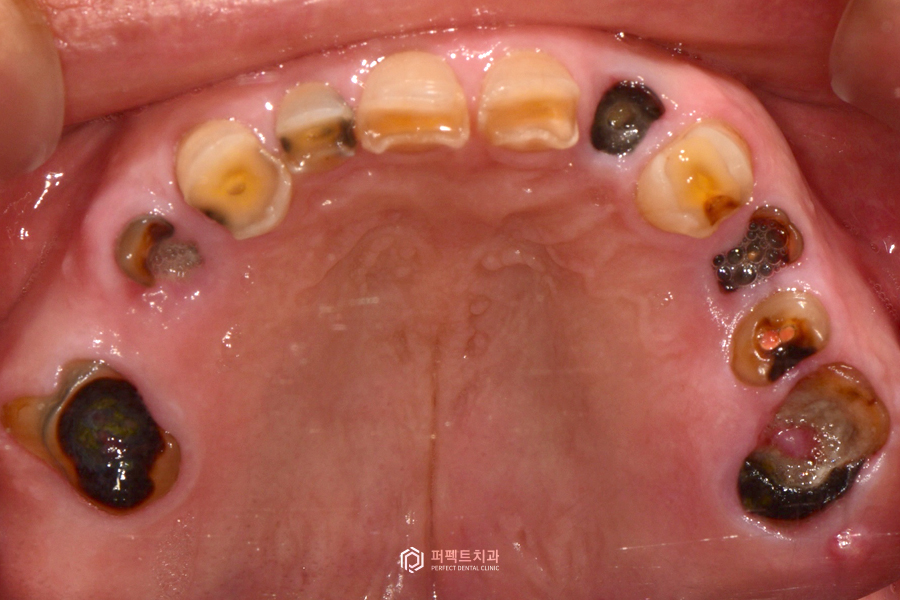 살릴 수 있는 치아가 없다면?❌｜전체임플란트 수복 관련 이미지 9