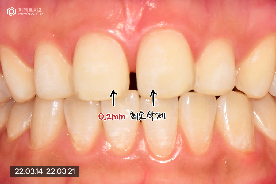 앞니 돌출 있는데 폴리네이트로 극복 가능..?🤔 관련 이미지 5