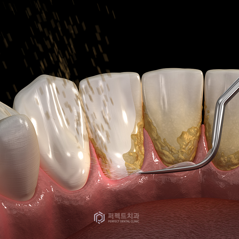 스케일링을 하면 치아가 깎이나요? 관련 이미지 5