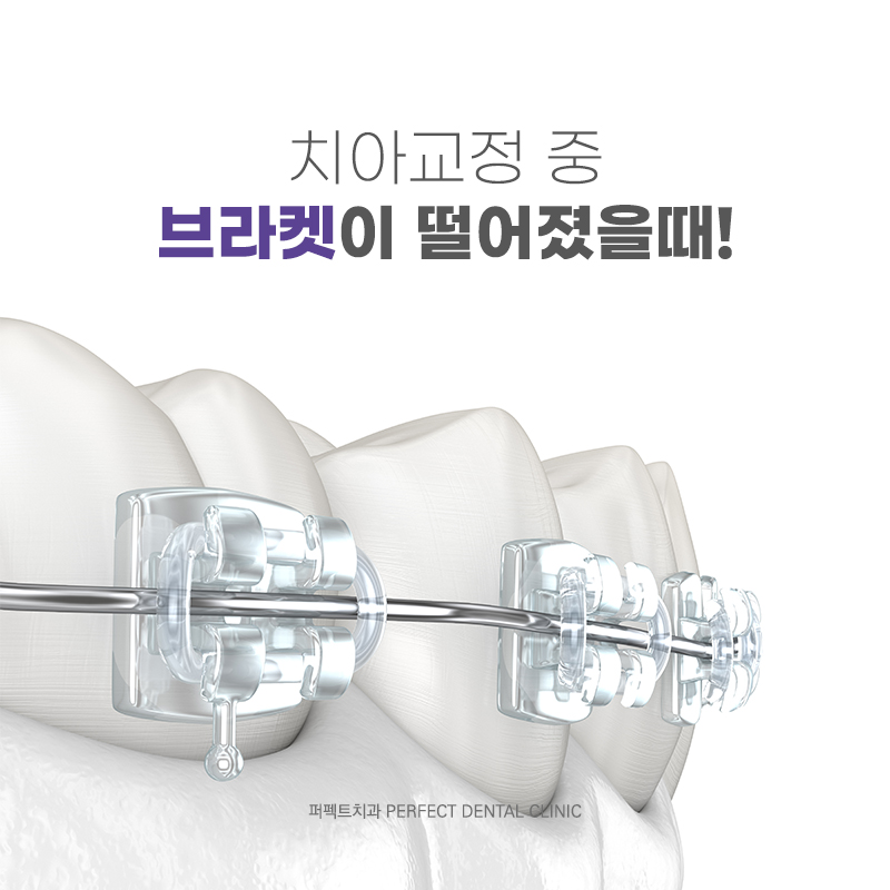 치아교정 중 주의해야 하는 음식, 왜? 관련 이미지 3