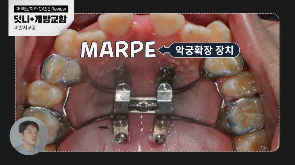 덧니+개방교합, MARPE를 이용한 비발치교정 관련 이미지 7