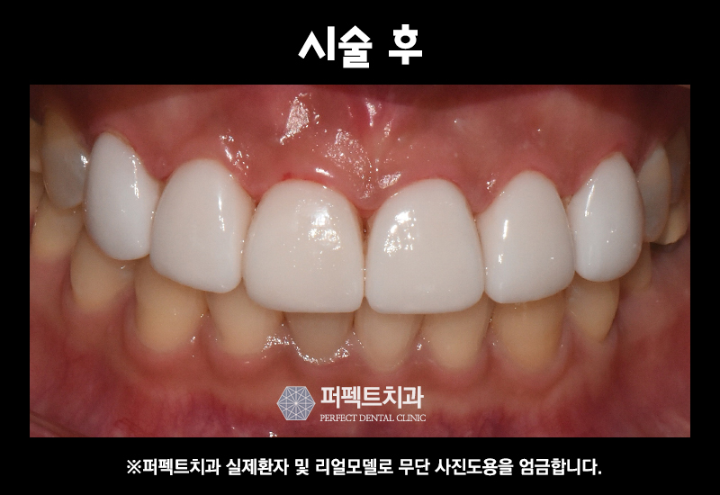 앞니 라미네이트 관련 이미지 7