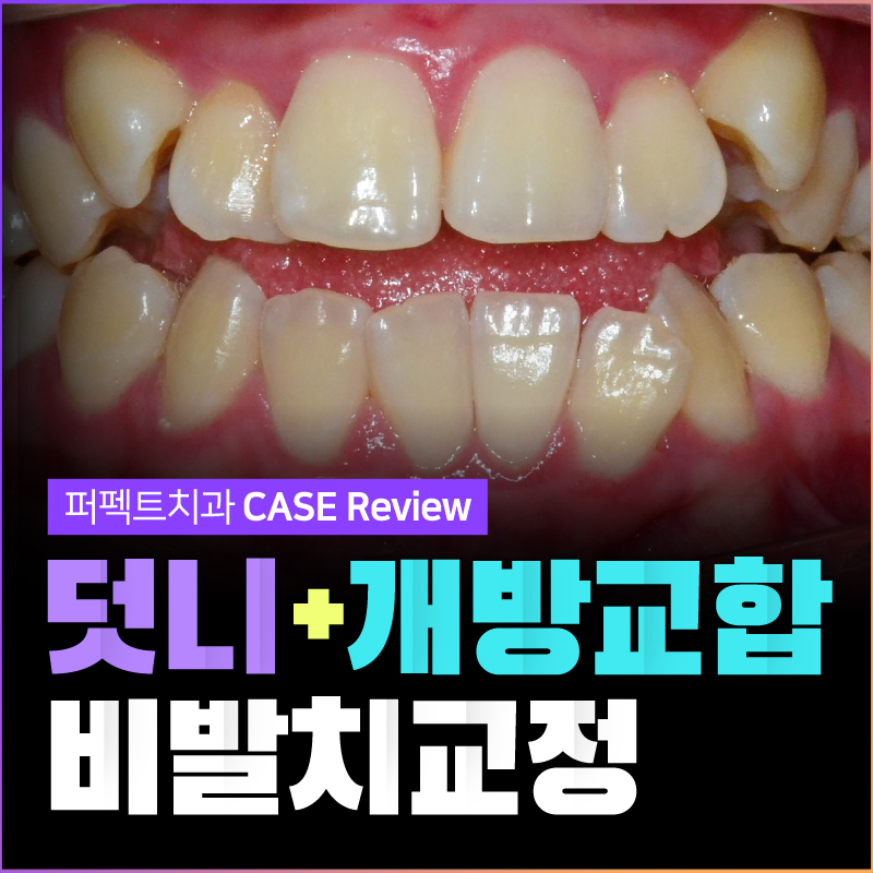 비발치로 덧니,개방교합 교정하기! 관련 이미지 1