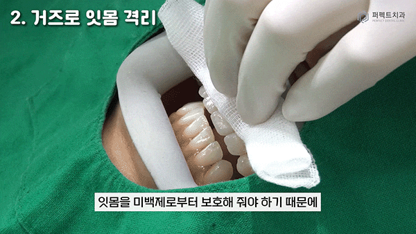 직접 받아본✨치아미백 과정① 관련 이미지 3