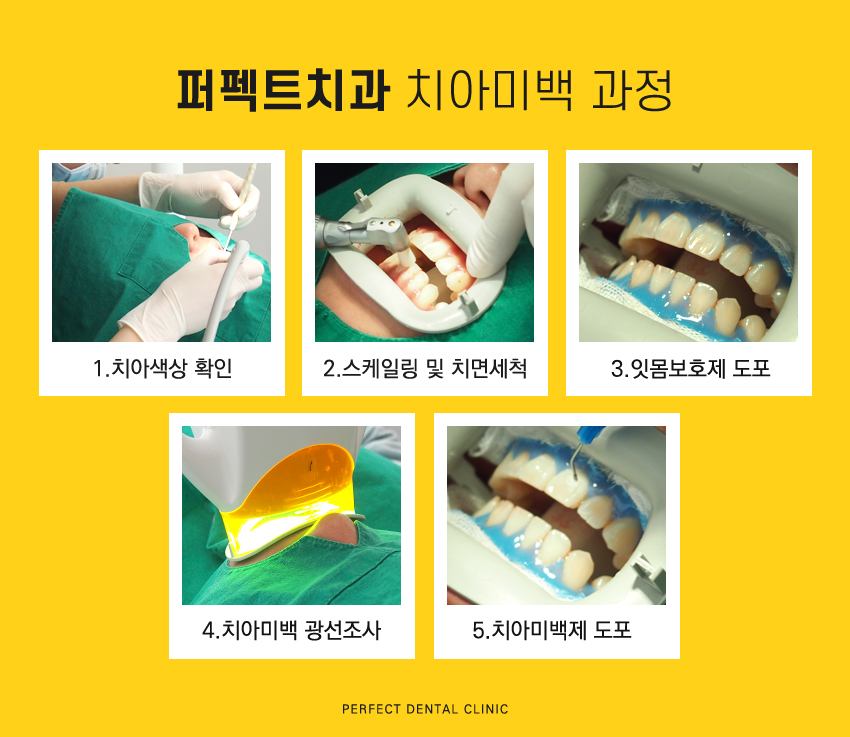 누런이 스트레스는 치아미백으로! 관련 이미지 4