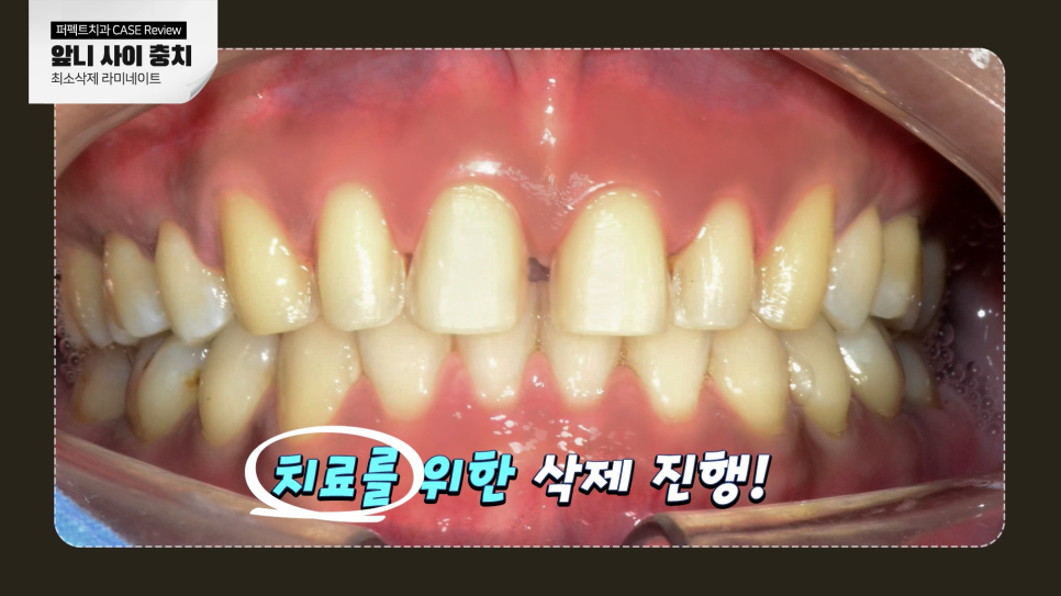 앞니 사이 충치, 어떻게 치료해야 티 안 날까? 관련 이미지 10