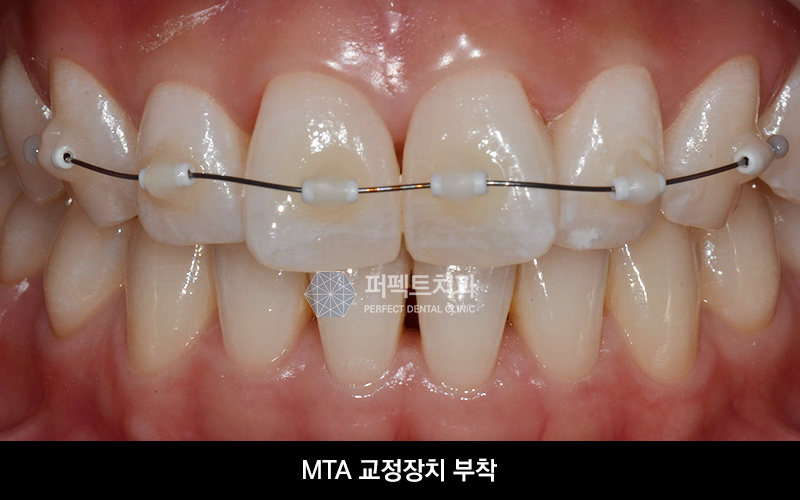 3개월 단기교정 비용과 기간은? 관련 이미지 3