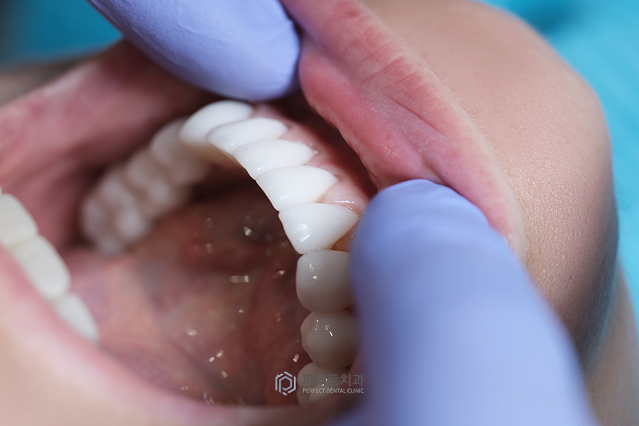 라미네이트 후 치실 사용 가능? 불가능? 관련 이미지 5