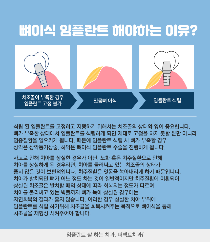 임플란트뼈이식 필요한 사람들에게~ 관련 이미지 2