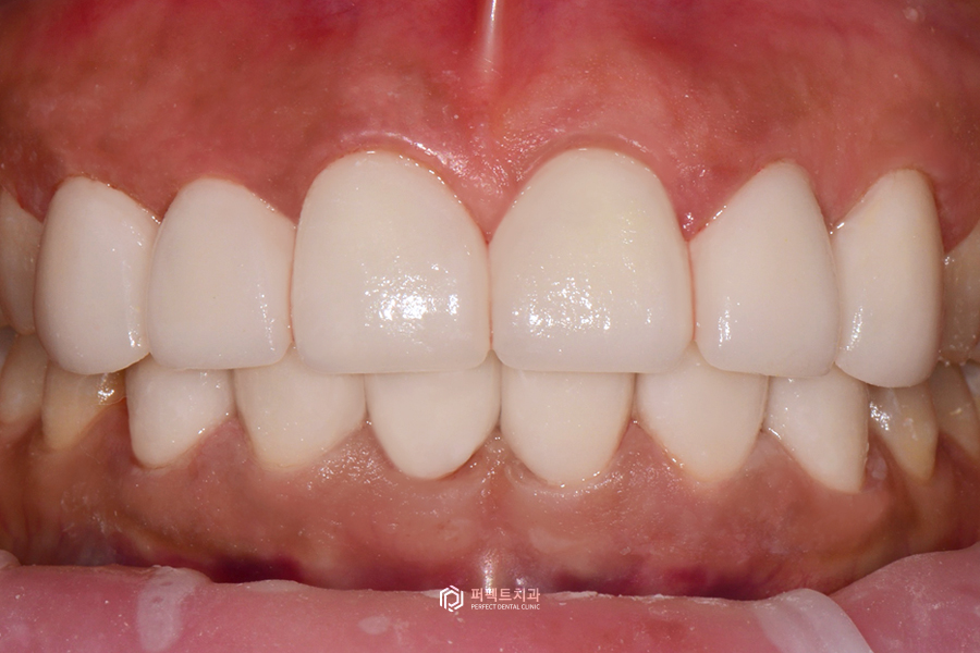치료해도 자꾸 벌어지는 치아..😨 원인은? 관련 이미지 4