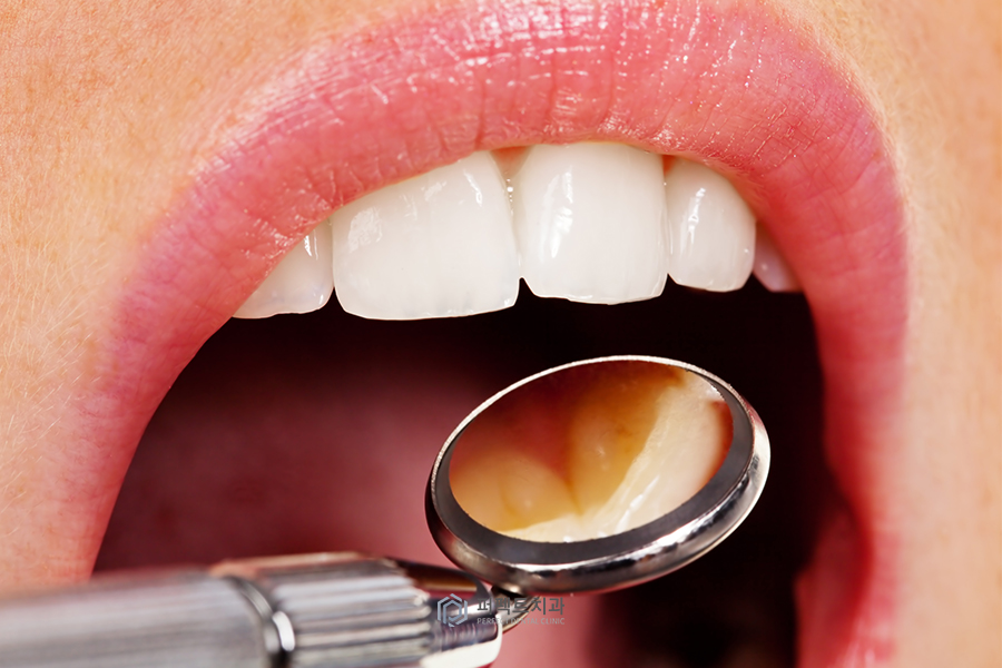 충치치료 했는데 아파요..(크라운&치아크랙) 관련 이미지 3