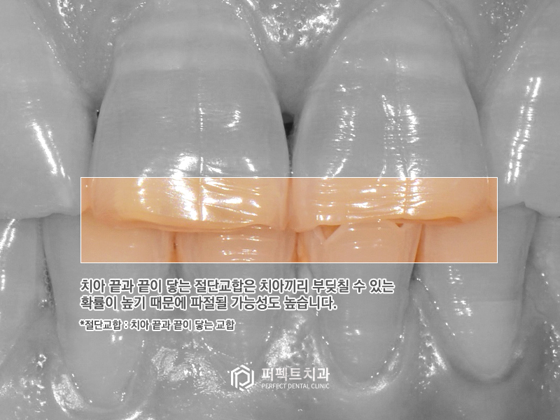 테트라사이클린 치아변색 폴리네이트 케이스 관련 이미지 3