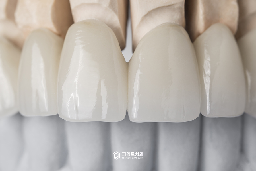 보철치료 후 치아가 벌어지는 이유는? 관련 이미지 3