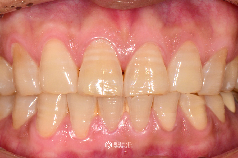 치아에 줄이 있다? 테트라사이클린이란? 관련 이미지 2