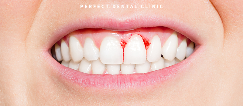 잇몸에 염증 종류와 치과치료 관련 이미지 2