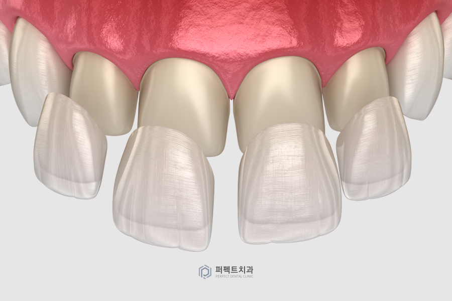 특별한 라미네이트가 있을까? 관련 이미지 2