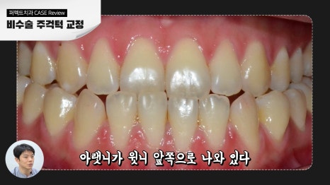 비수술 주걱턱 교정 결과 관련 이미지 2