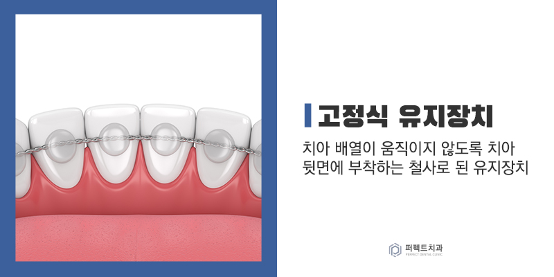 교정 후 라미네이트, 유지장치는? 관련 이미지 2