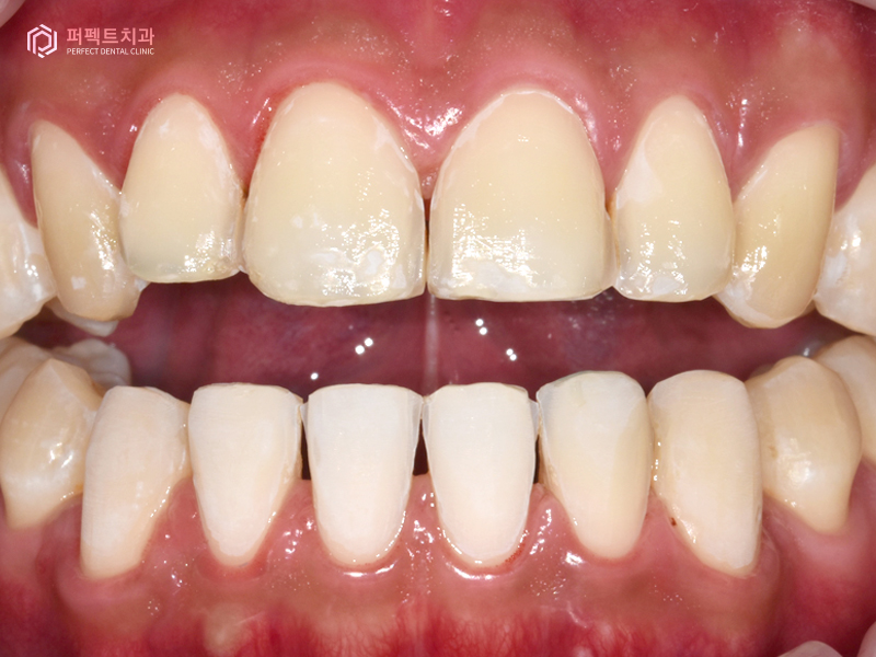 남자라미네이트, 폴리네이트 두가지 케이스 관련 이미지 5