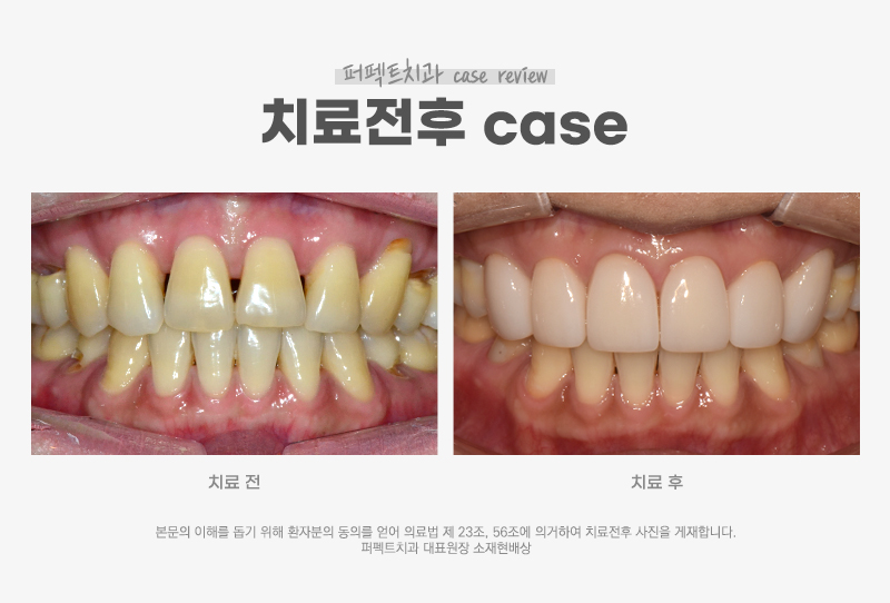 블랙트라이앵글+노란치아 폴리네이트 case 관련 이미지 5