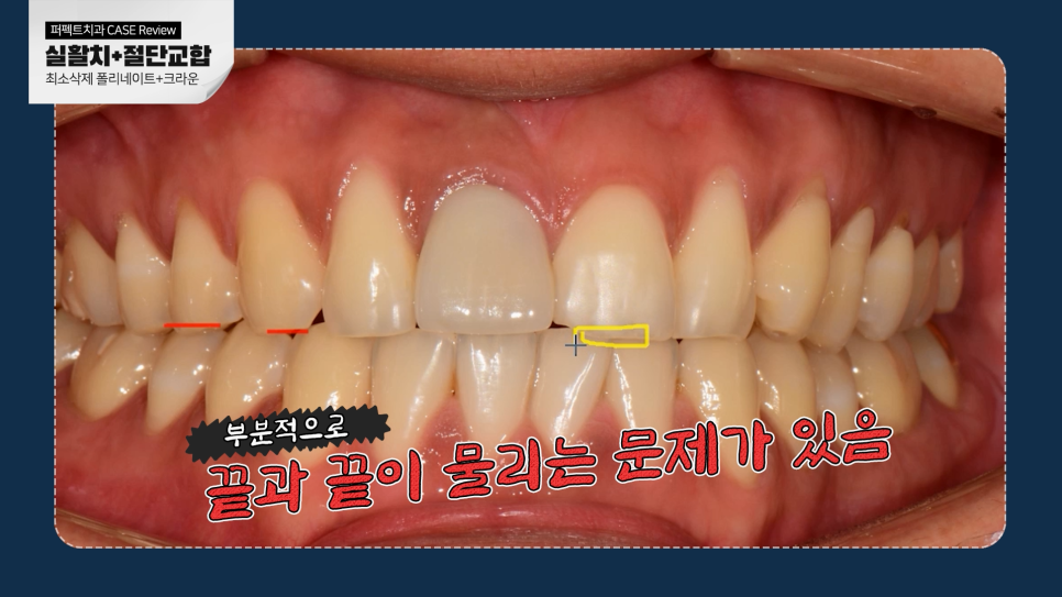 남자라미네이트, 더 오래 사용하려면? 관련 이미지 5