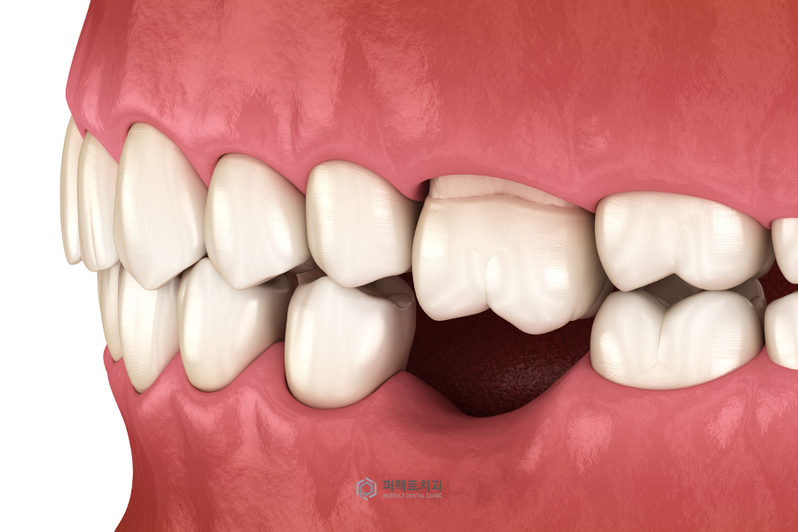 치아교정 미니스크류|꼭 심어야되나요?, 통증은? 관련 이미지 3