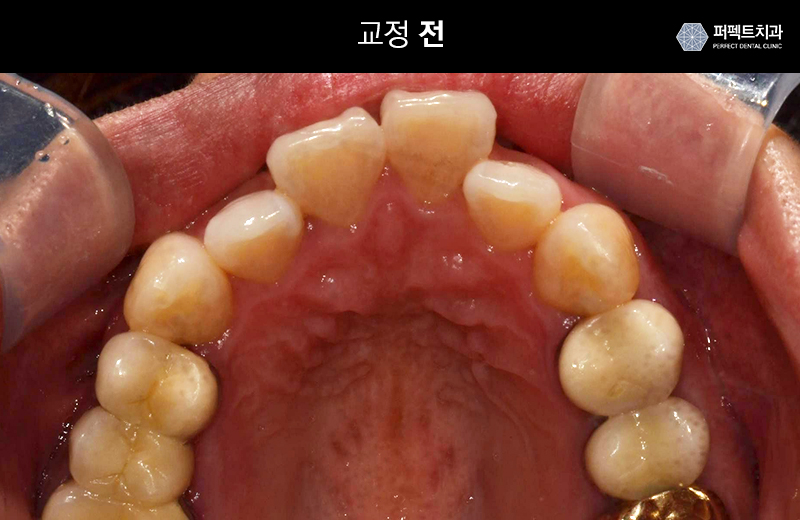 클리피시교정 기간과 비용 관련 이미지 3