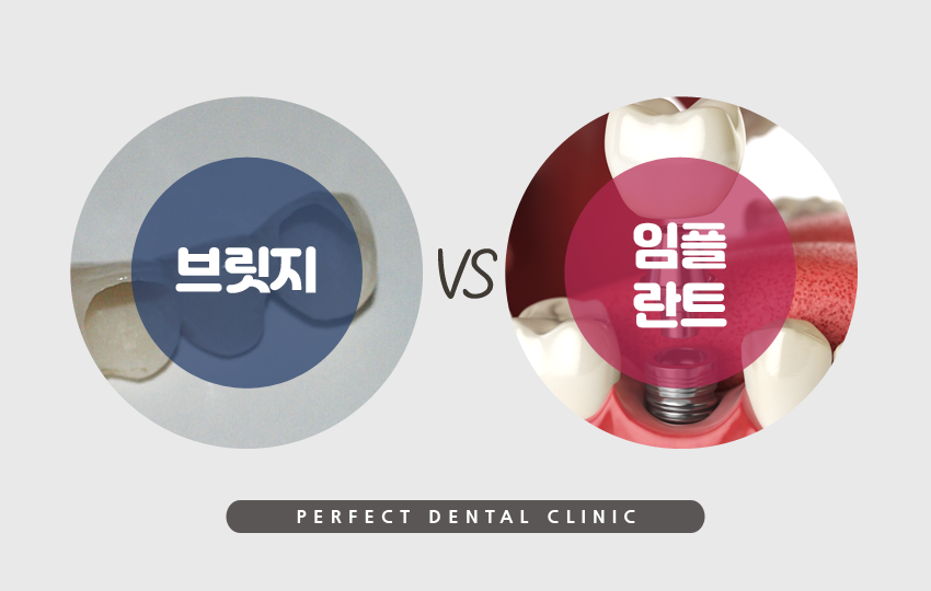 치아상실했을때 브릿지로? 관련 이미지 3