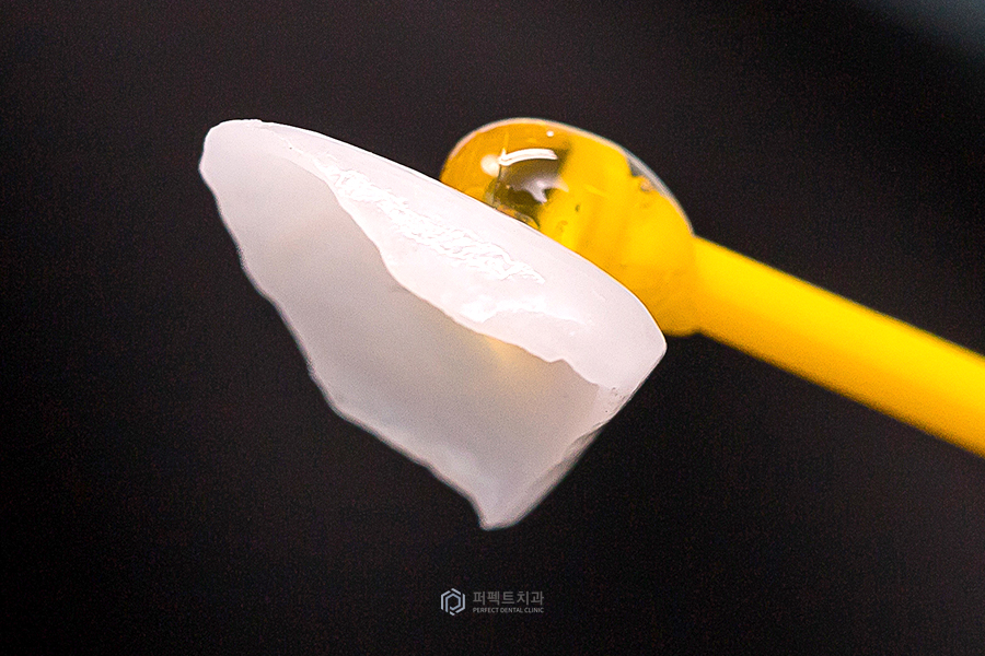 라미네이트가 떨어졌는데 꼭 재시술 해야할까요? 관련 이미지 2