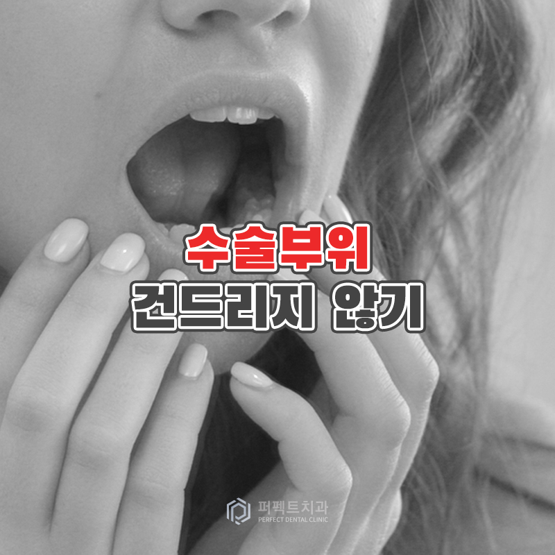 임플란트 수술 후 주의사항은? 관련 이미지 5
