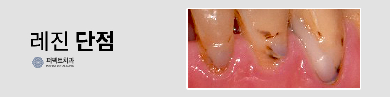 앞니 레진 변색, 라미네이트 or 크라운? 관련 이미지 3