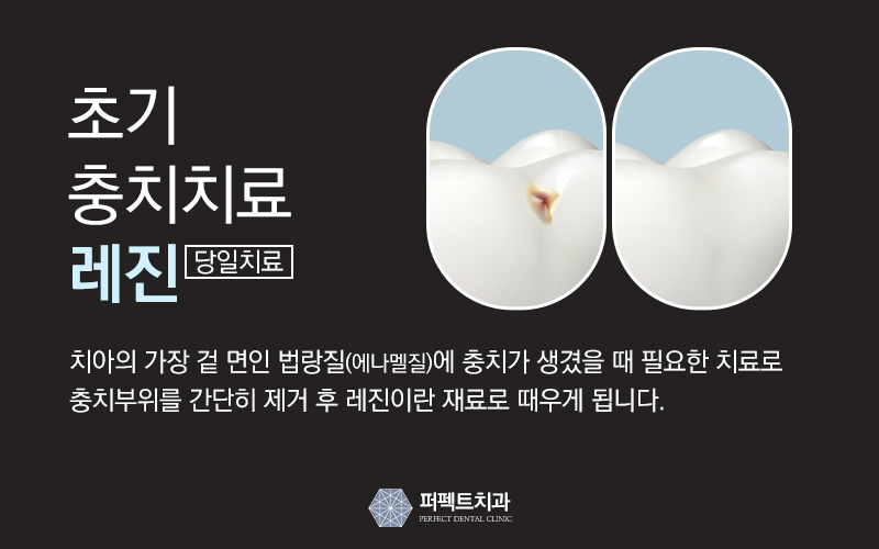 충치치료가격 관련 이미지 4