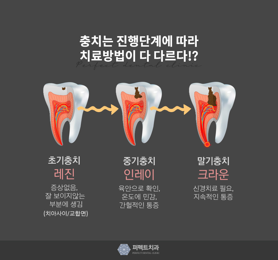 앞니충치, 어떤 치료를 받아야할까? 관련 이미지 2