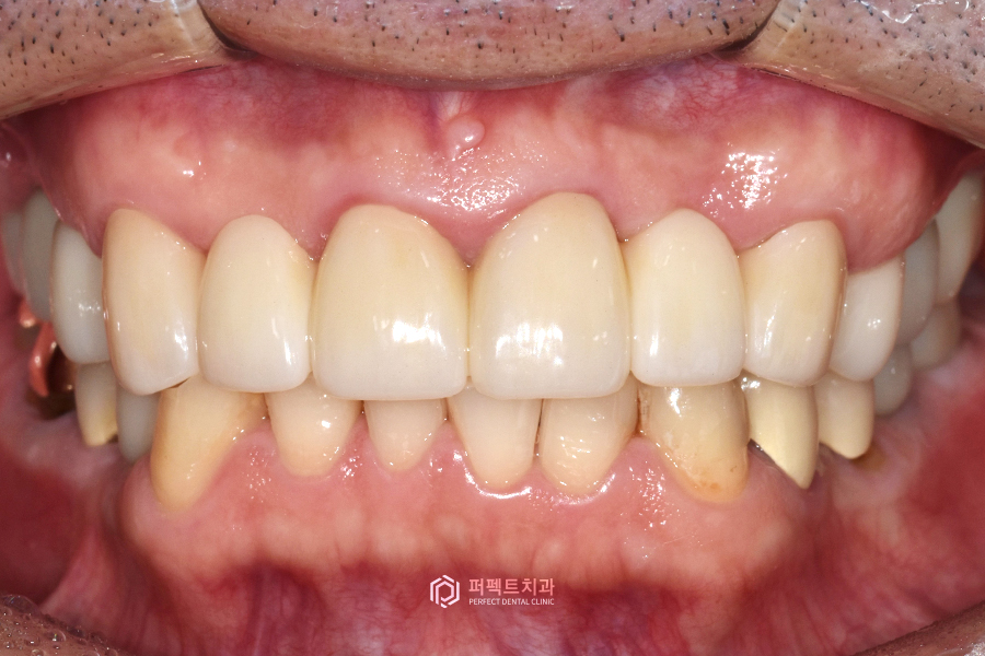 어금니가 없어 앞니로 음식을 드셨던..😰 어떻게 변했을까? 관련 이미지 9