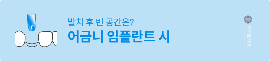 임플란트 후, 발치된 빈 공간이 걱정된다면? 관련 이미지 2