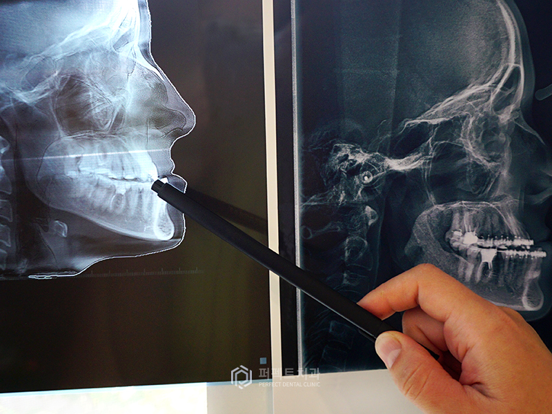 돌출입 교정 시 입을 얼마나 넣을 수 있을까? 관련 이미지 5