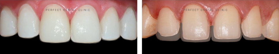 라미네이트가 떨어졌을때, 어떻게 하죠? 관련 이미지 2