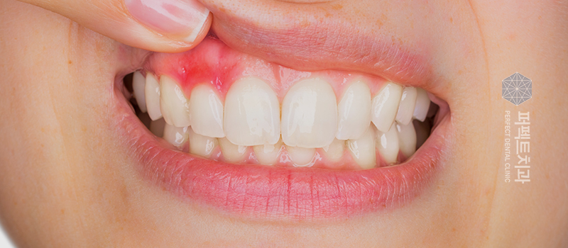 잇몸물혹 방치하게 되면? 관련 이미지 3