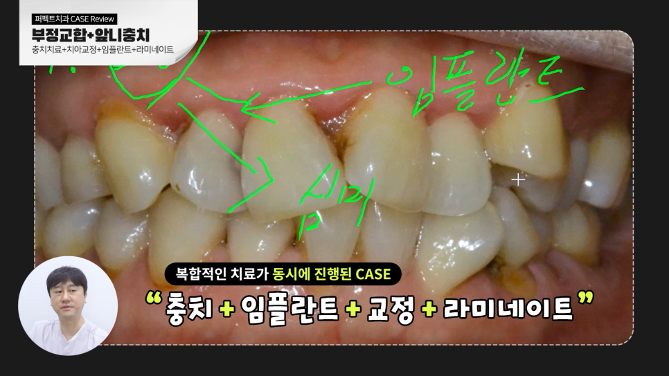 [부정교합+충치] 복합적인 문제를 가진 치아, 치료결과는? 관련 이미지 3