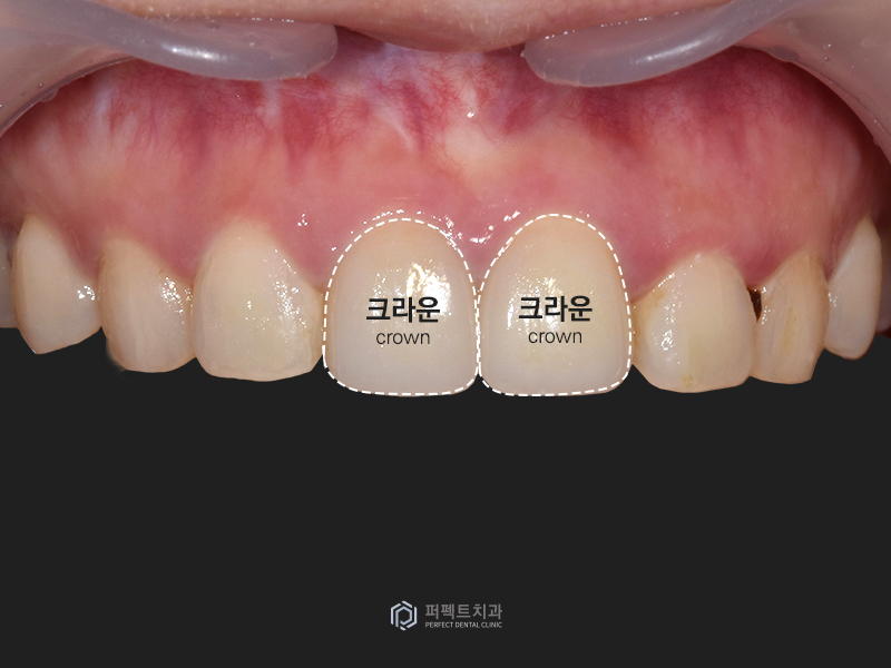 오래된 보철물 교체 및 폴리네이트까지! 관련 이미지 3