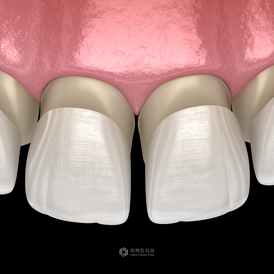 벌어진 앞니 치료 방법은? 관련 이미지 3