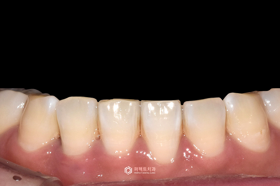 라미네이트 디자인👄｜치과의사가 고른 것vs환자가 고른 것, 어떤 걸로? 관련 이미지 3