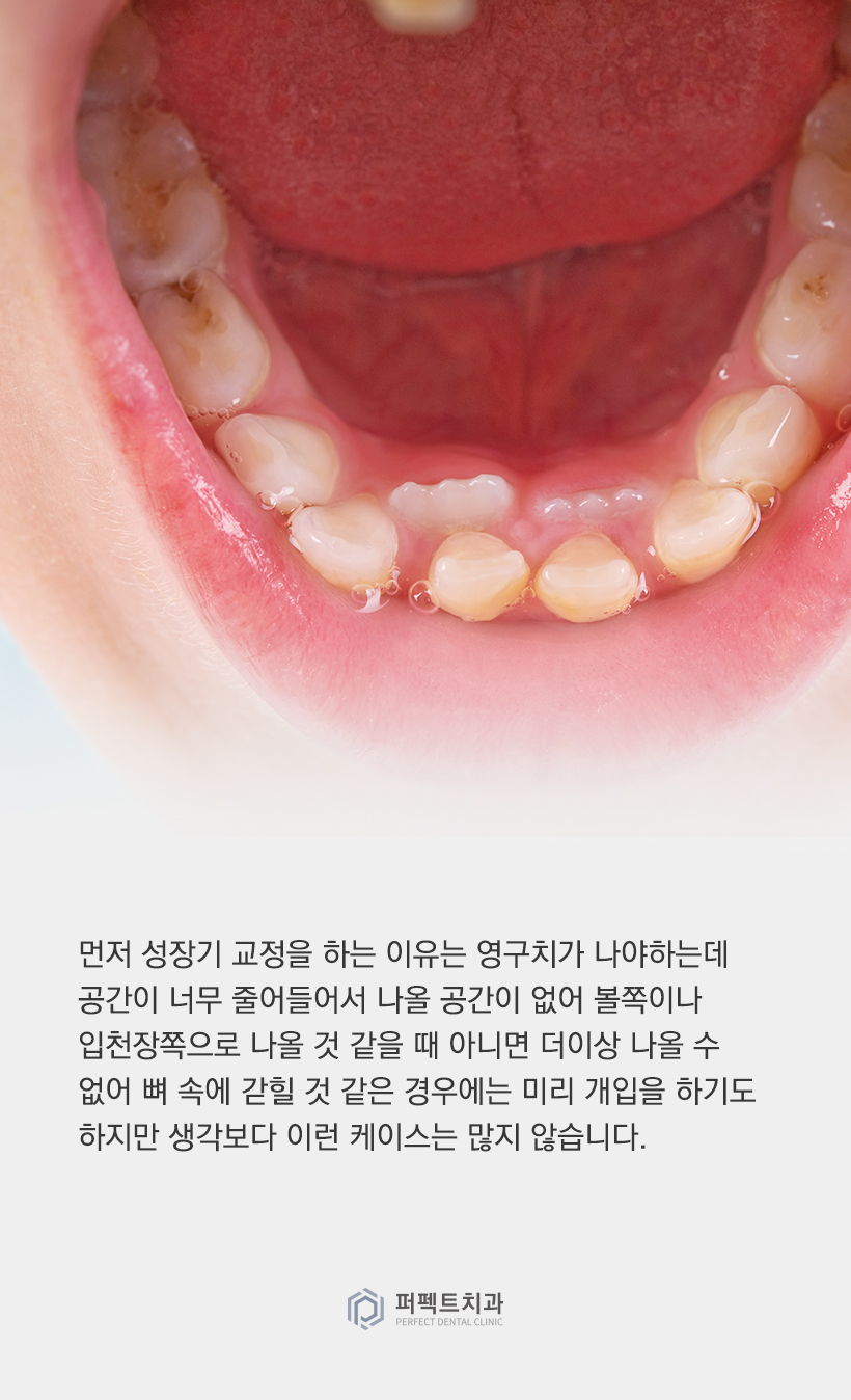 치아교정은 몇 살 때부터 할 수 있을까? 관련 이미지 2
