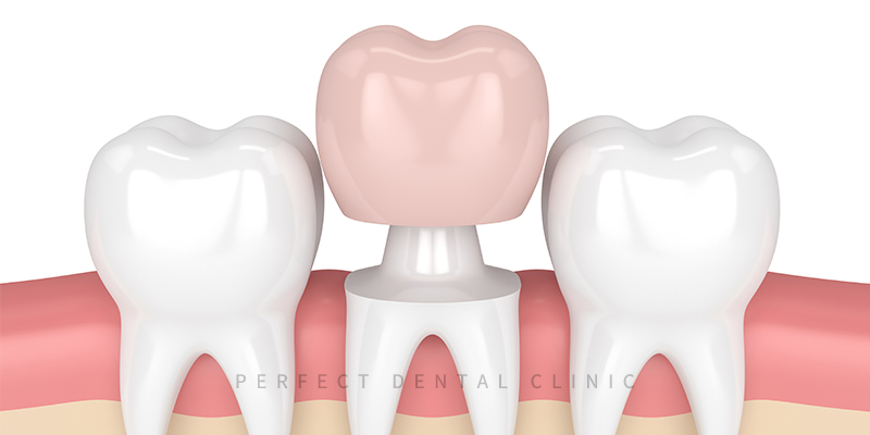 충치치료 지르코니아 크라운 가격! 관련 이미지 3
