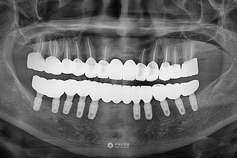 윗니 전체 신경치료 했다고?😱 교합평면이 뭐길래 관련 이미지 7