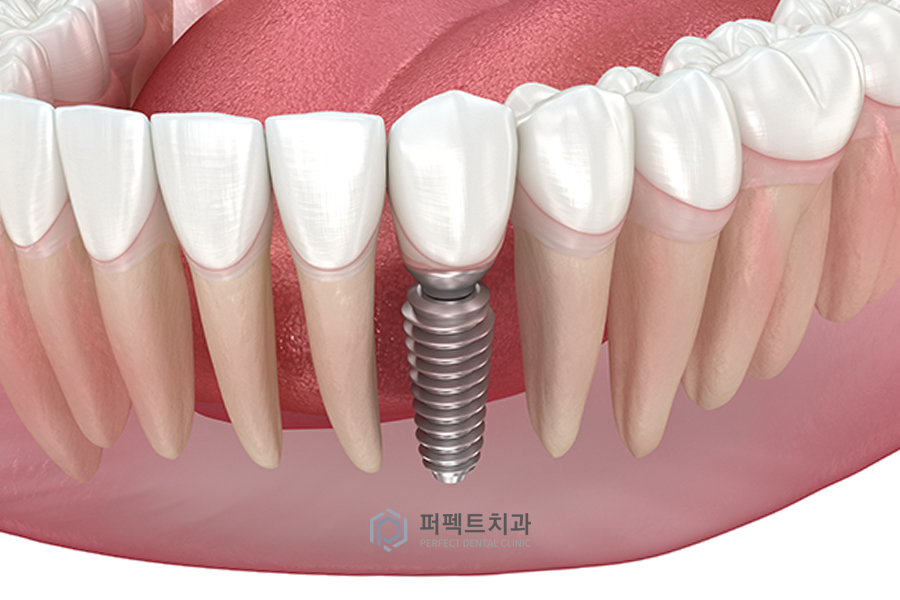 치아가 없을 때 할 수 있는 치료? - ①임플란트편 관련 이미지 2